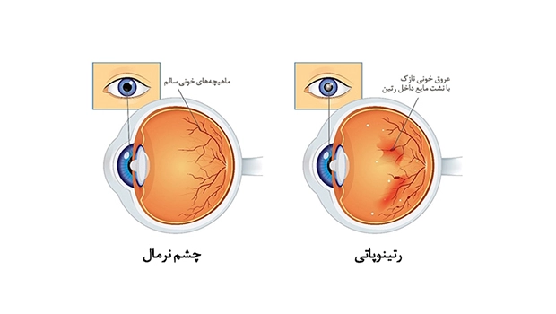 Retinal (3) بیماری های شبکیه چشم