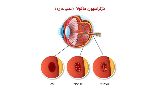 Retinal (5) بیماری های شبکیه چشم