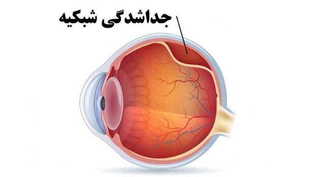 Retinal (7) بیماری های شبکیه چشم