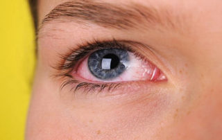 مراقب عفونت‌های ویروسی چشم باشید