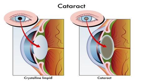 عمل جراحی آب مروارید یا کاتاراکت - مرکز چشم پزشکی سلامت غرب تهران