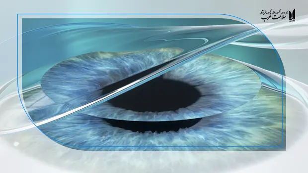 مزایا و معایب لازک