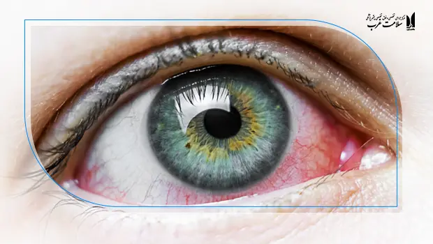 مراقبت های بعد لازک