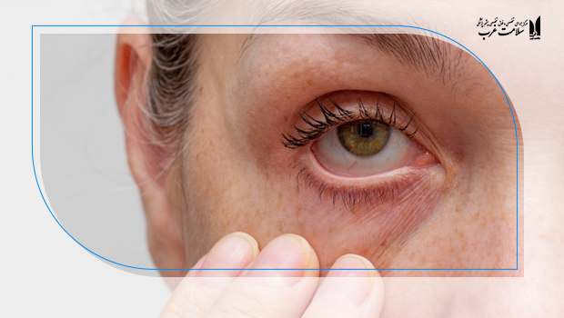 تعریف و طبقه‌بندی خشکی چشم