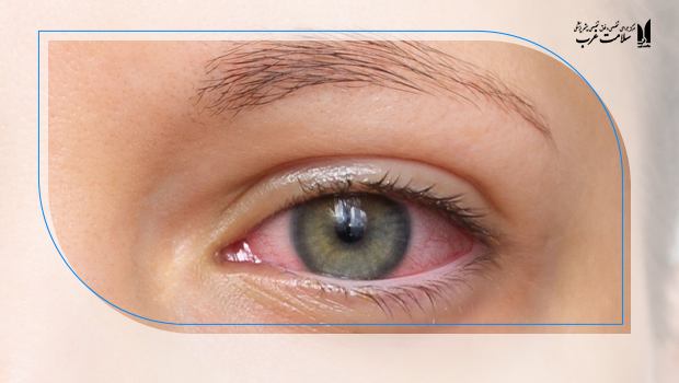 خشکی چشم تبخیری (Evaporative)